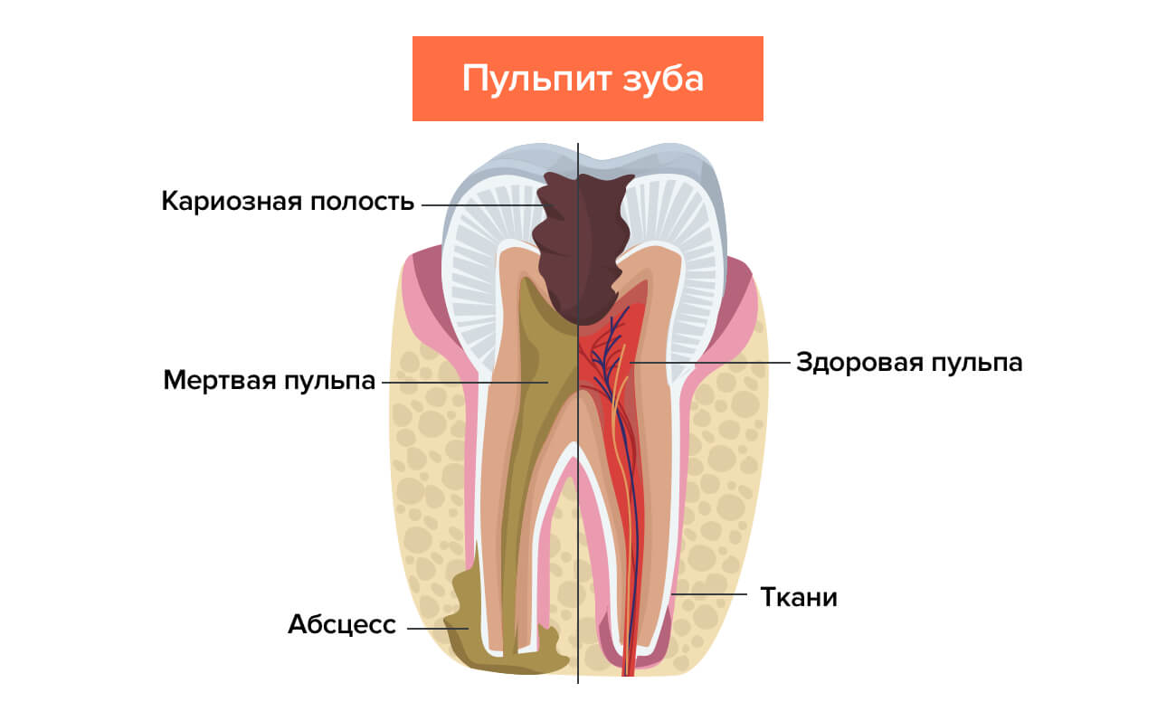 Лечение пульпита двухканального зуба thumbnail