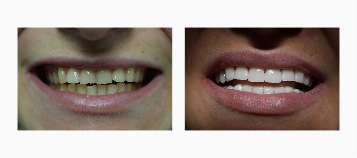 Фото пациента до и после установки голливудских виниров