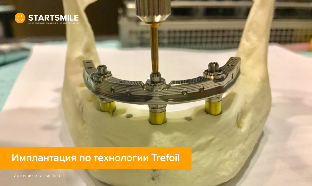 Макет имплантации по технологии Trefoil