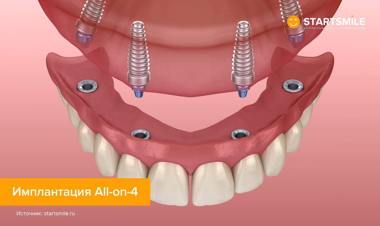 Имплантация All-on-4 в картинках