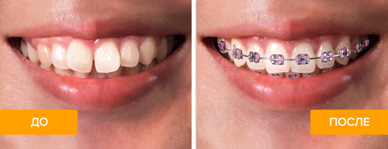 Фото пациента до и после выравнивания зубов брекетами
