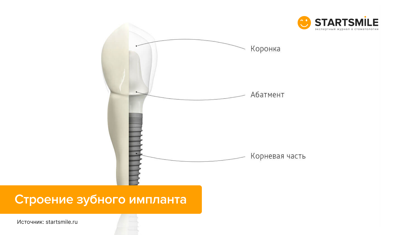 Строение зубного импланта на картинке.