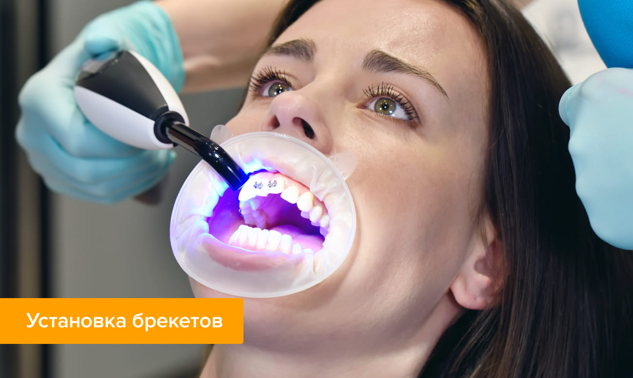 Фото процесса установки брекетов на зубы пациентки 