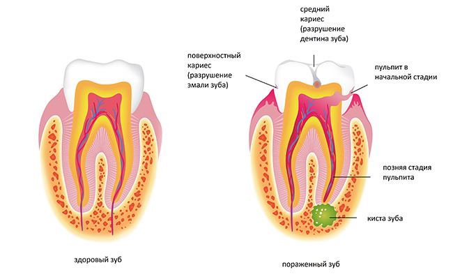 Этапы формирования кисты зуба