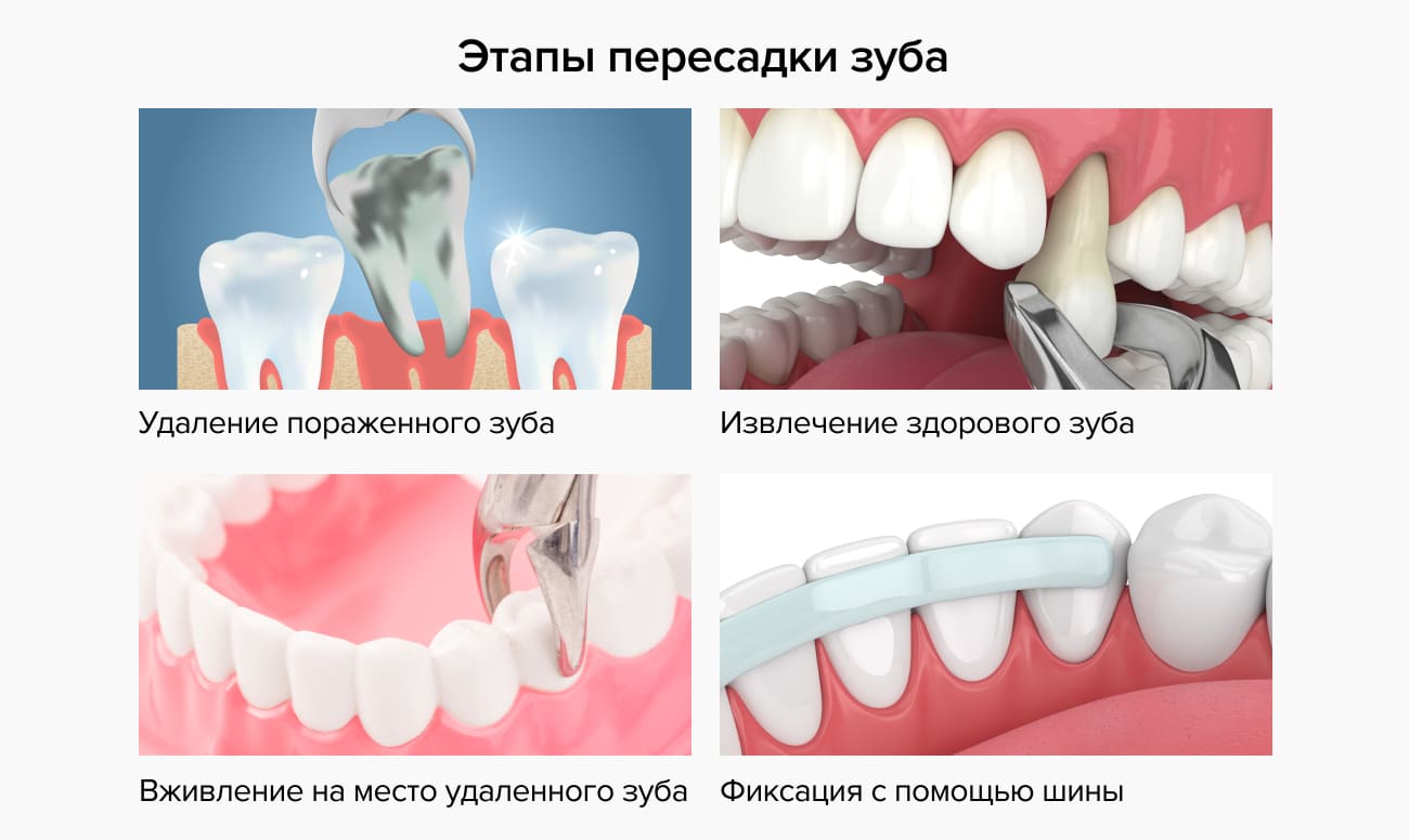 Этапы пересадки зуба в картинках