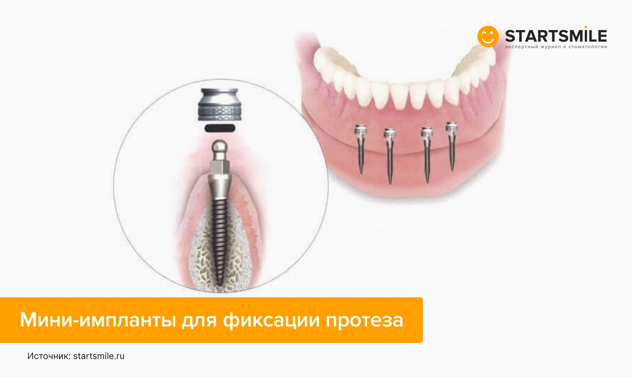 Съемный протез на мини-имплантах в картинках