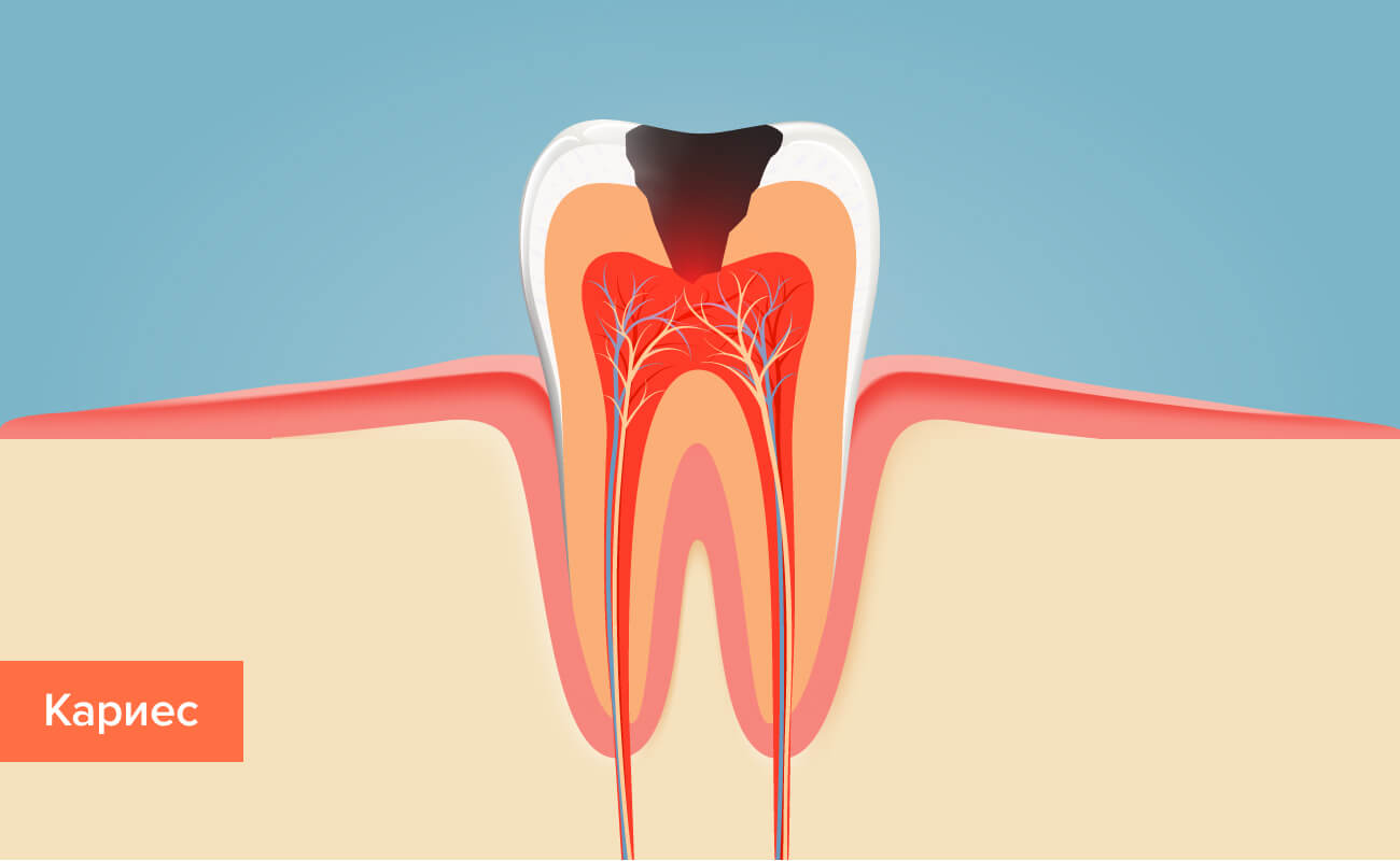 Кариес на зубе в картинках