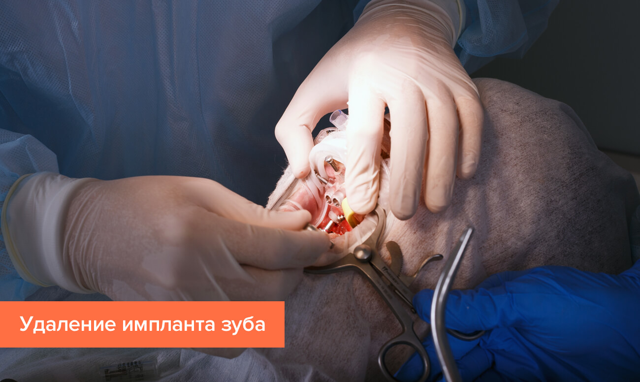 можно ли вытащить зубной имплант. Смотреть фото можно ли вытащить зубной имплант. Смотреть картинку можно ли вытащить зубной имплант. Картинка про можно ли вытащить зубной имплант. Фото можно ли вытащить зубной имплант