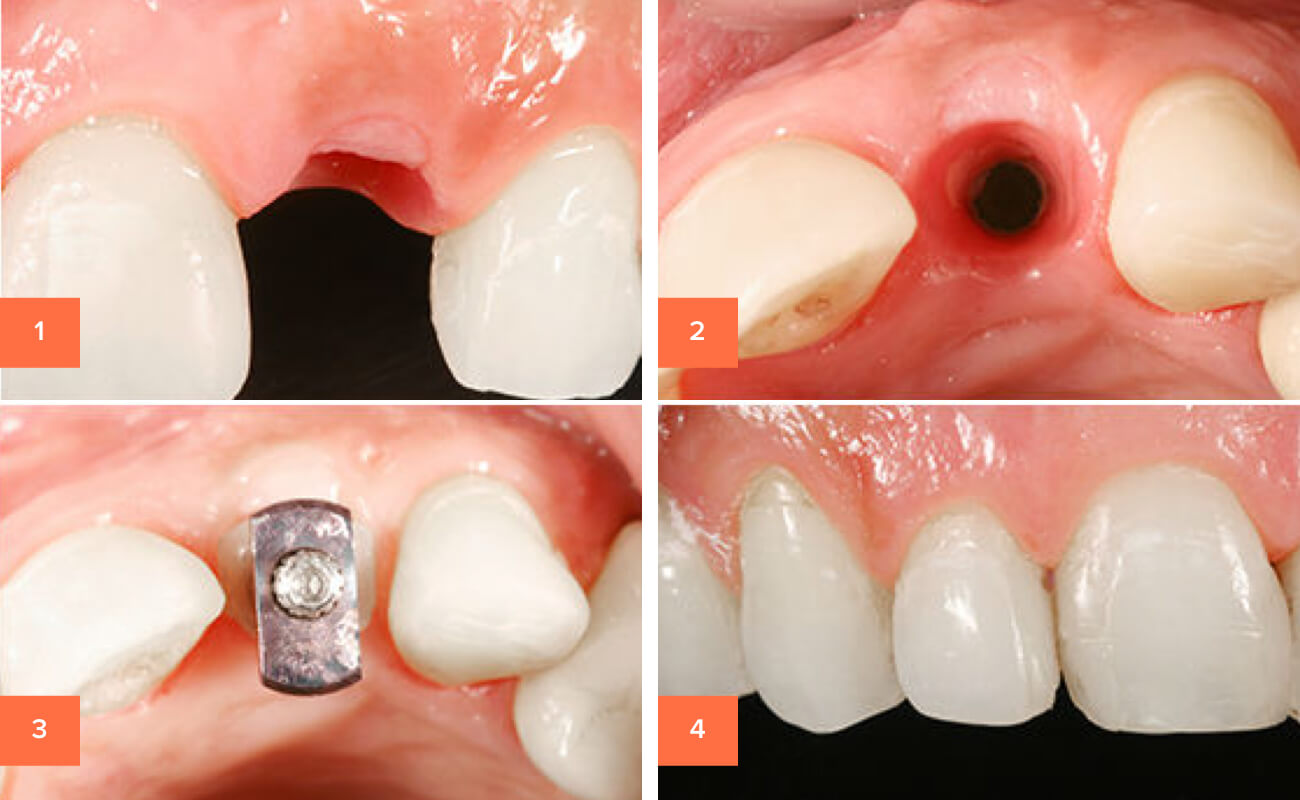 Фото на разных этапах экспресс-имплантации зубов
