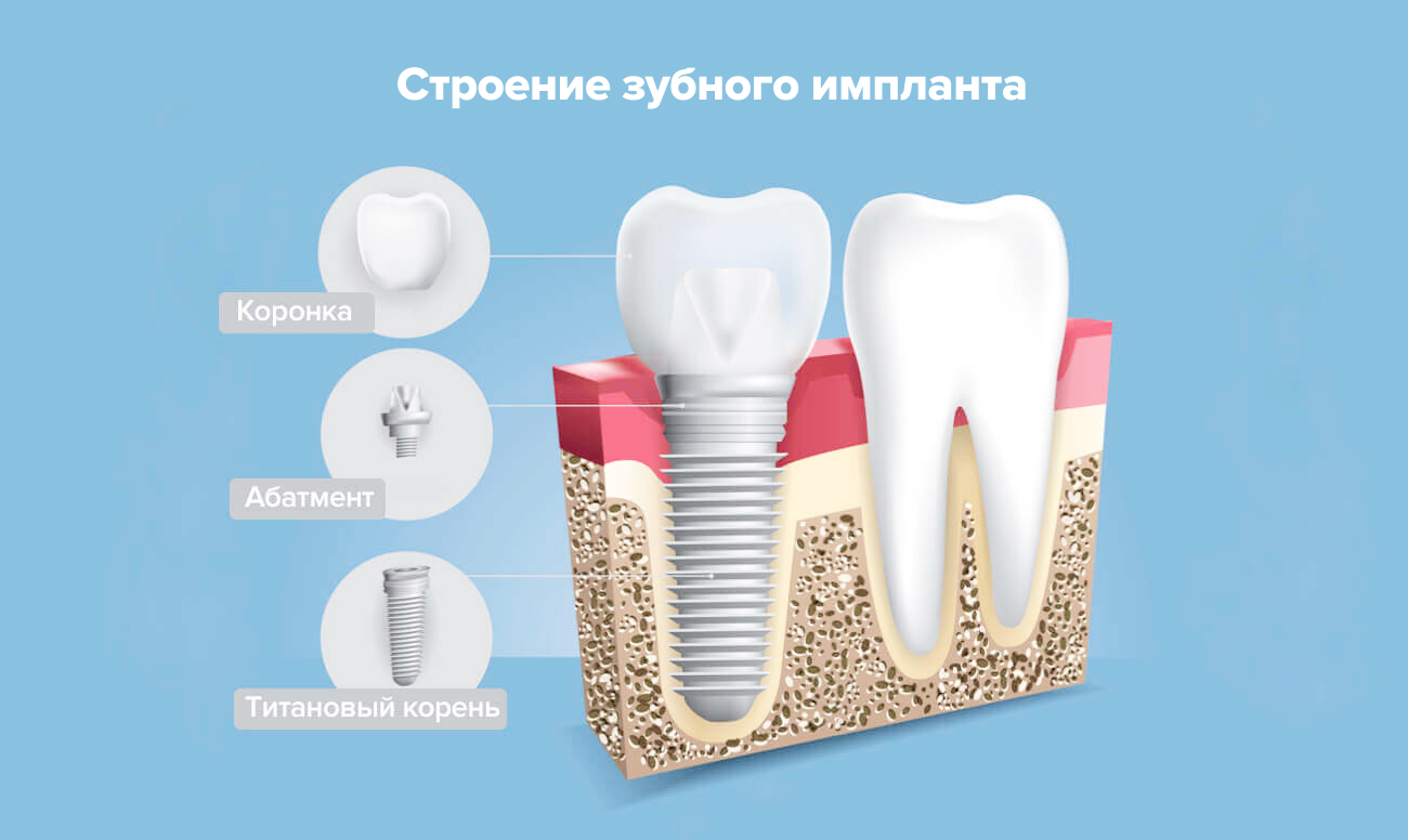 Строение зубного имплантата в картинках.