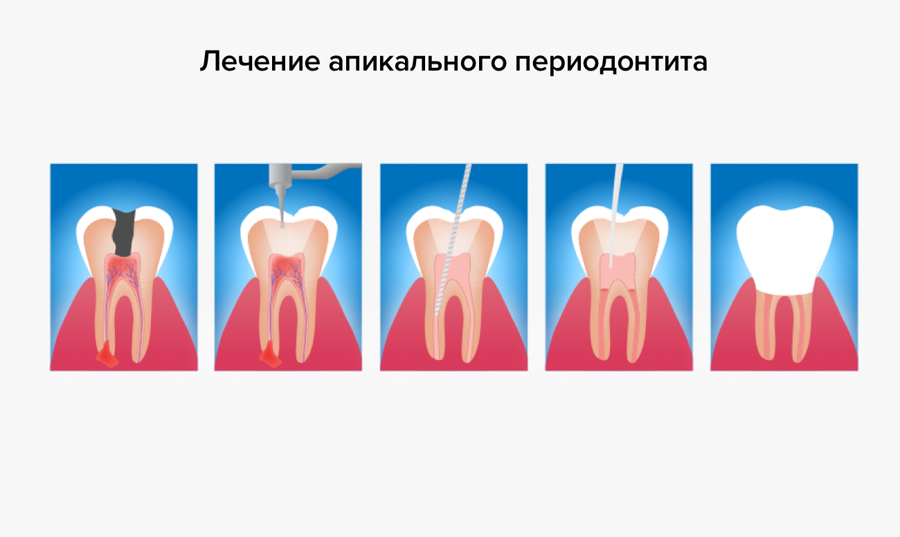 Лечение апикального периодонтита зуба в картинках