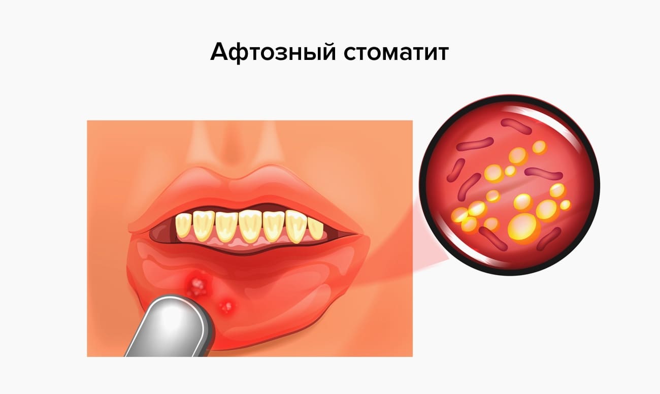 Афтозный стоматит в картинках