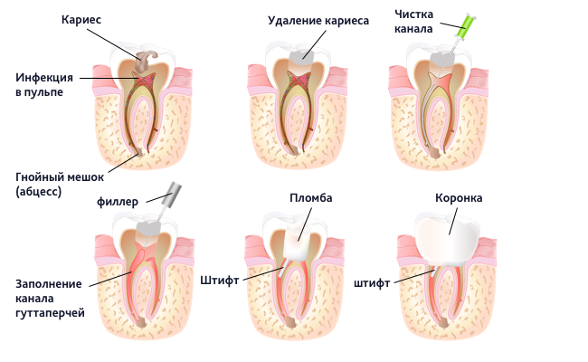 Фото лечения каналов зуба
