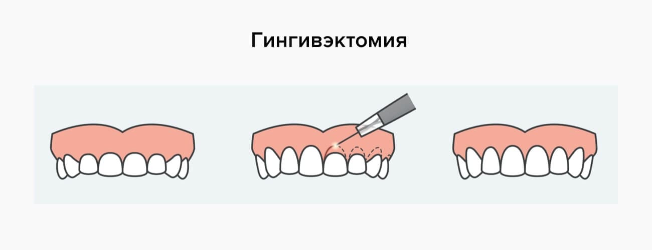  Гингивэктомия в картинках