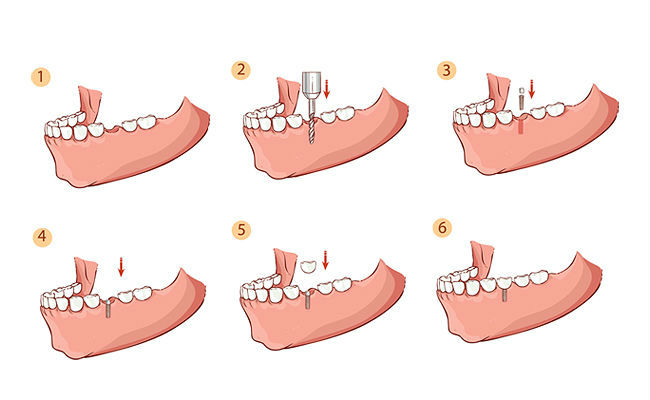 tekhnologiya implantacii zubov 4