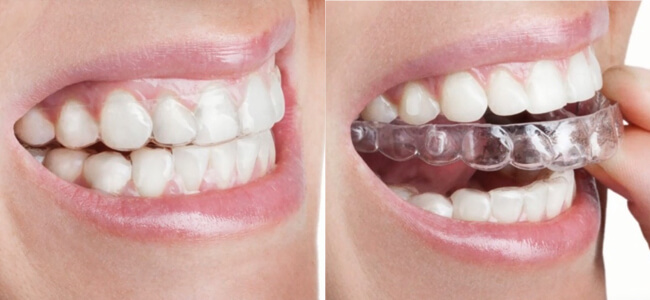 Фото элайнеров 3D Smile на зубах