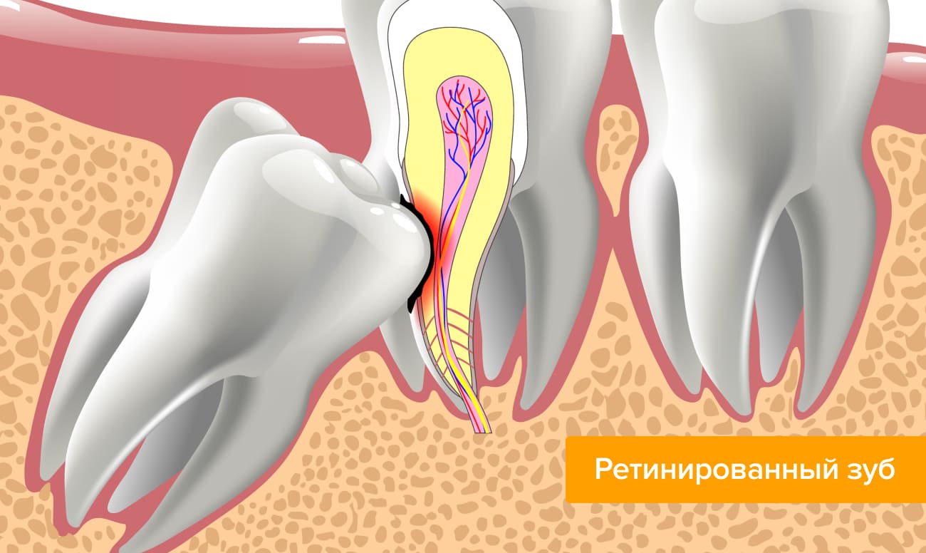 Ретинированный зуб в картинках