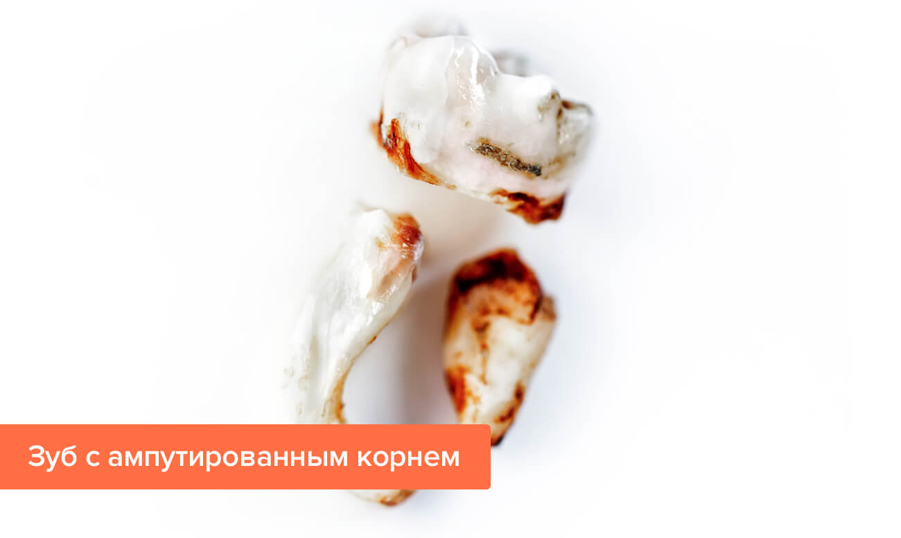Зуб болит после гемисекции thumbnail