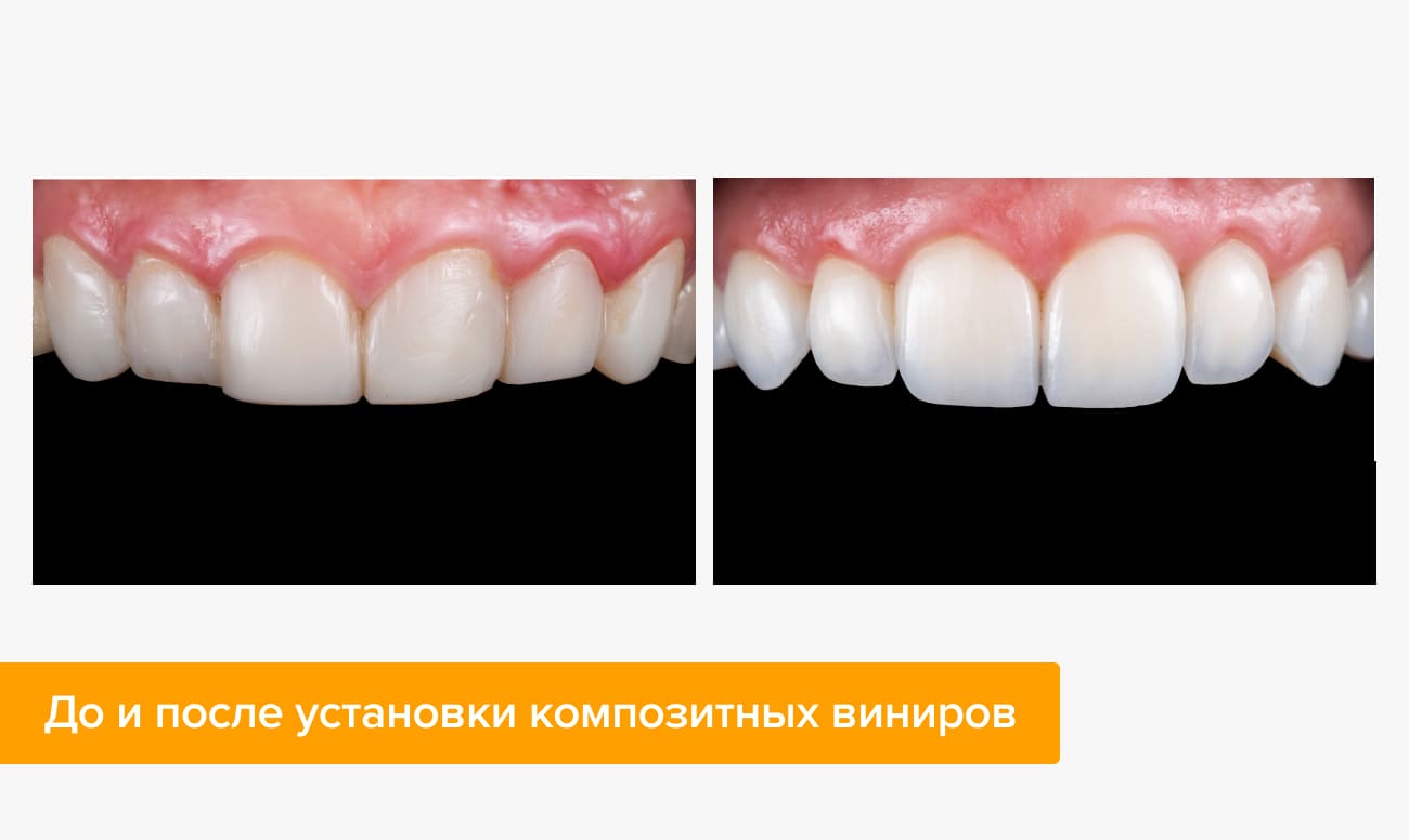До и после установки композитных виниров Фото до и после установки композитных виниров