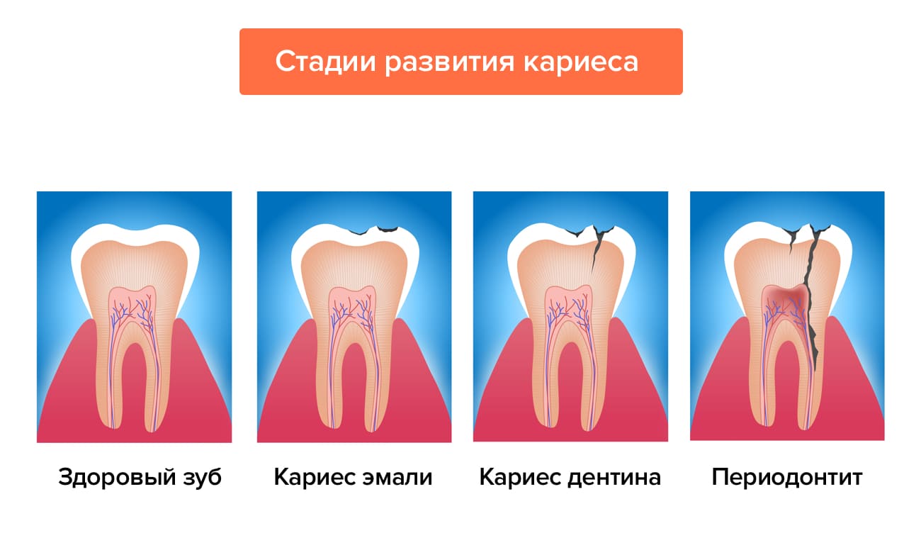 Стадии развития кариеса в картинках