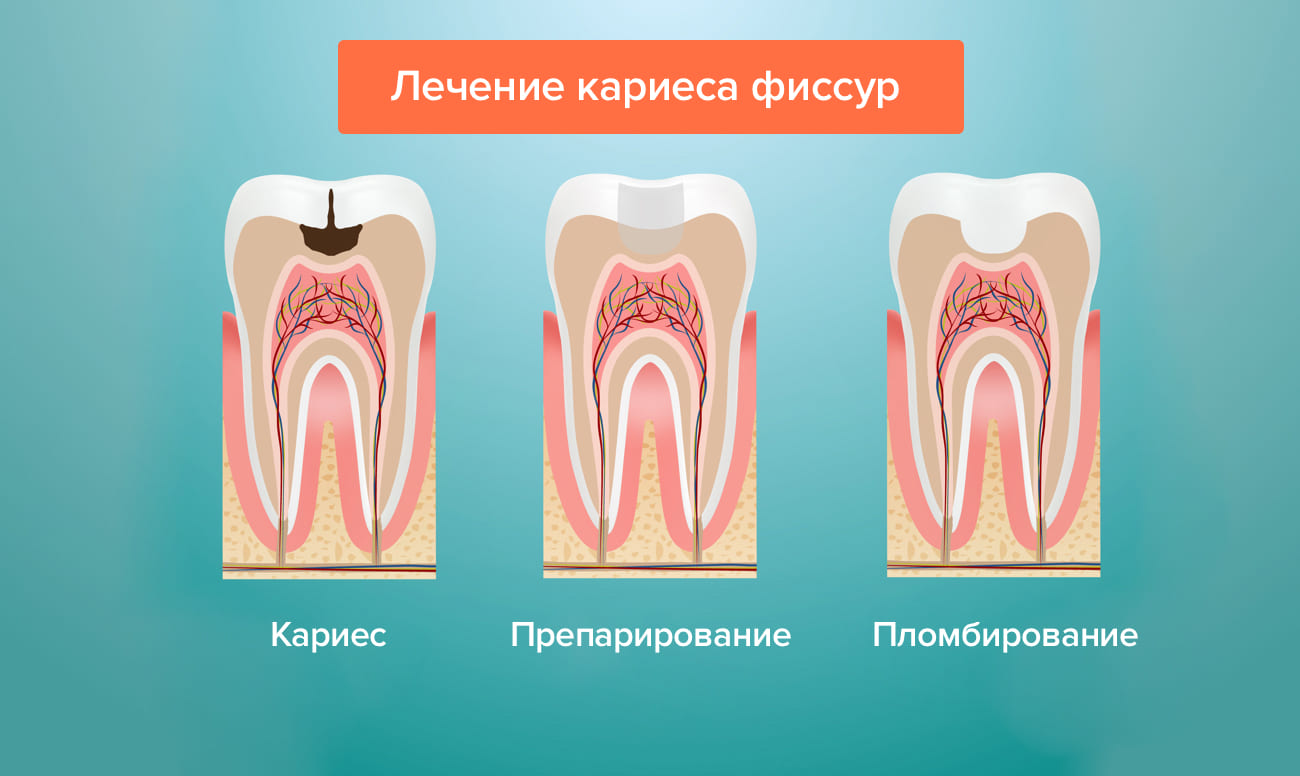 Лечение кариеса фиссур в картинках