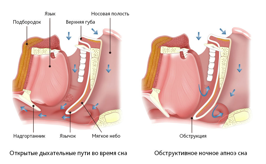 Синдром ночного апноэ в картинках