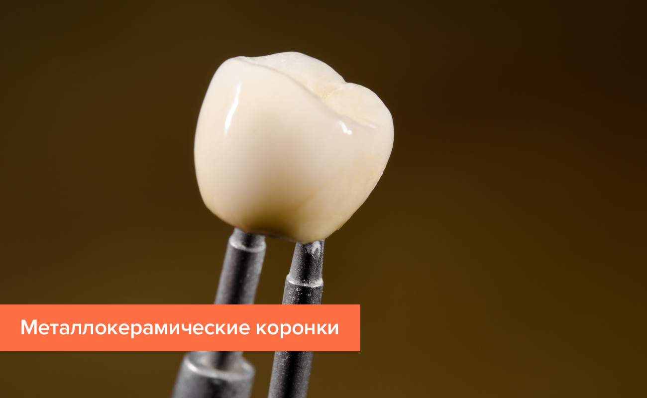 Коронка из металлокерамики Фото коронки из металлокерамики