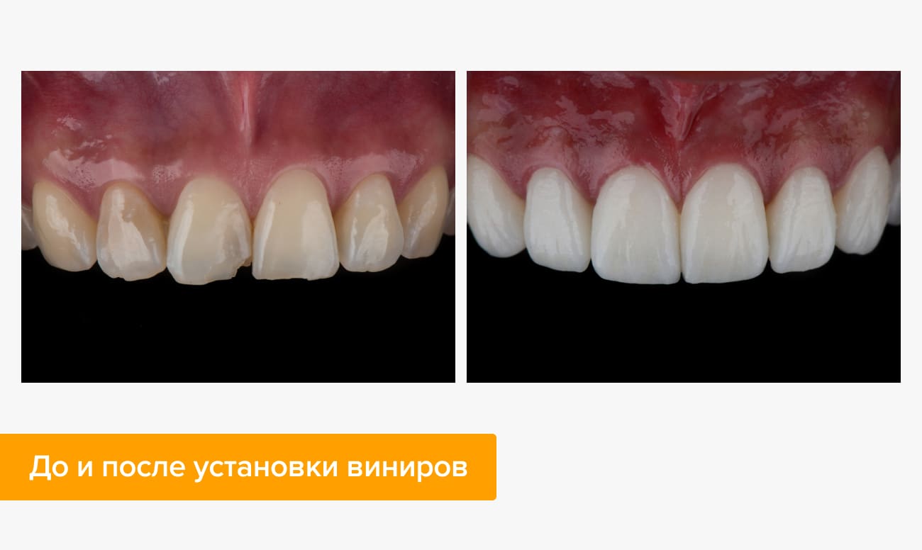 Фото зубов до и после установки виниров