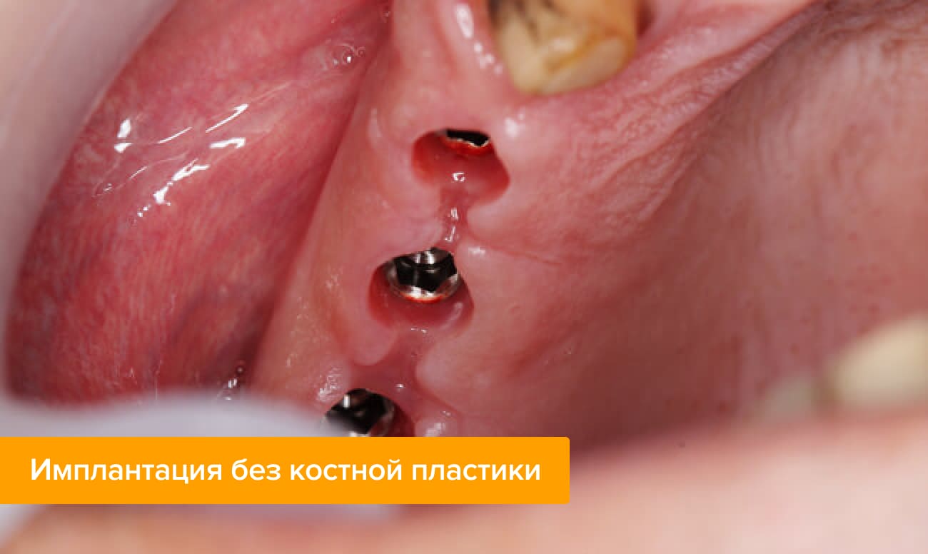 если не хватает костной ткани для имплантации что делать. Смотреть фото если не хватает костной ткани для имплантации что делать. Смотреть картинку если не хватает костной ткани для имплантации что делать. Картинка про если не хватает костной ткани для имплантации что делать. Фото если не хватает костной ткани для имплантации что делать
