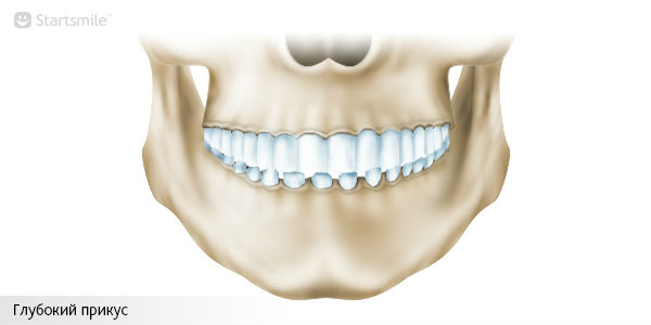 Глубокий прикус