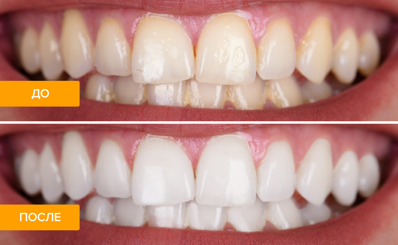 Результат до и после отбеливания зубов