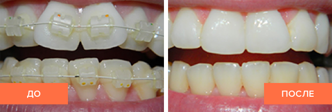 Фото пациента до и после лечения брекет-системой из керамики