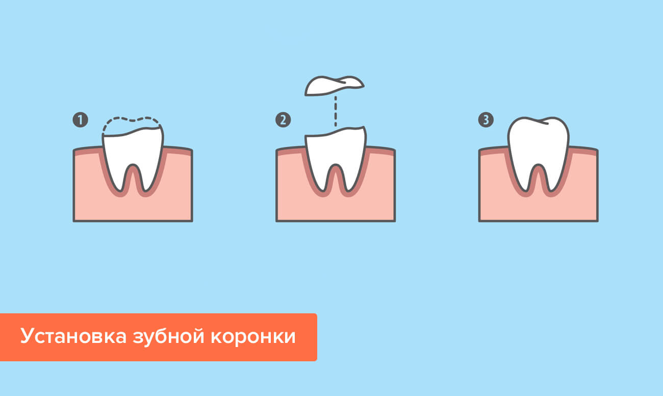 Установка зубной коронки в картинках Установка зубной коронки в картинках
