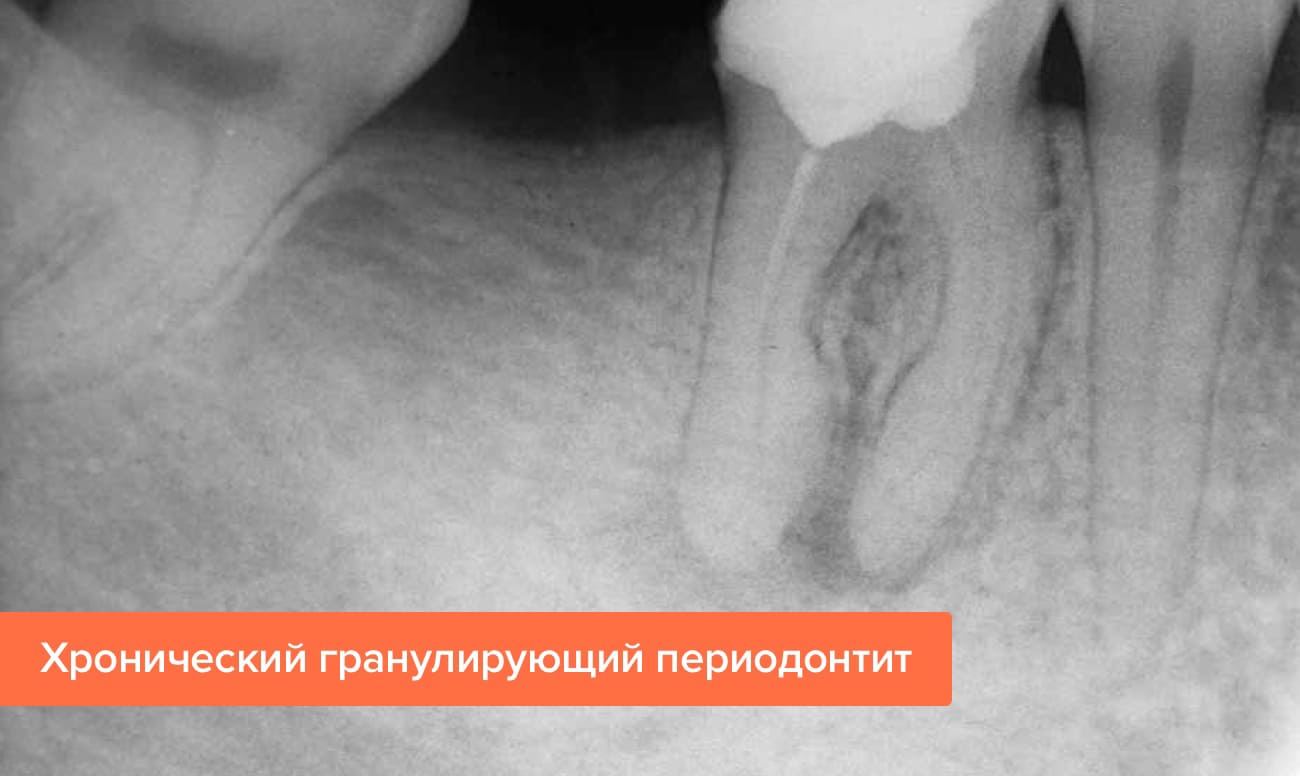 Фото хронического гранулирующего периодонтита