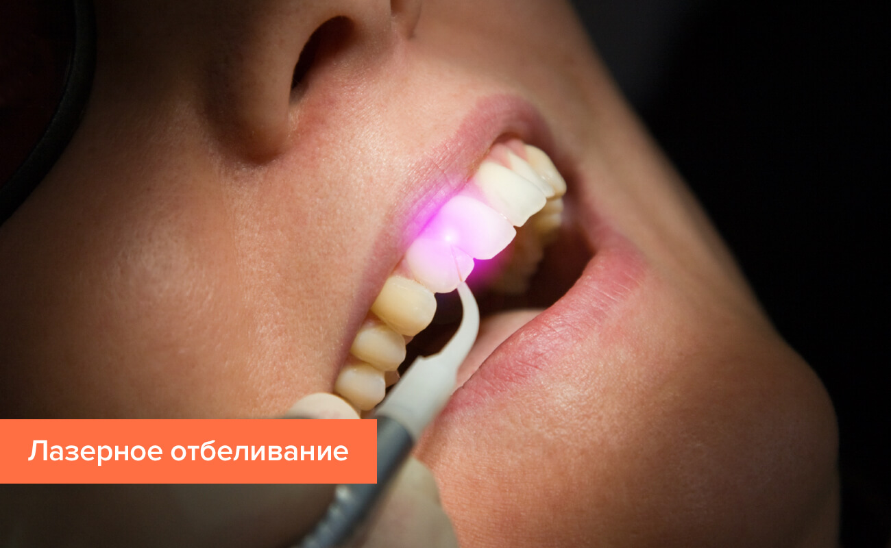 Фото процедуры лазерного отбеливания зубов