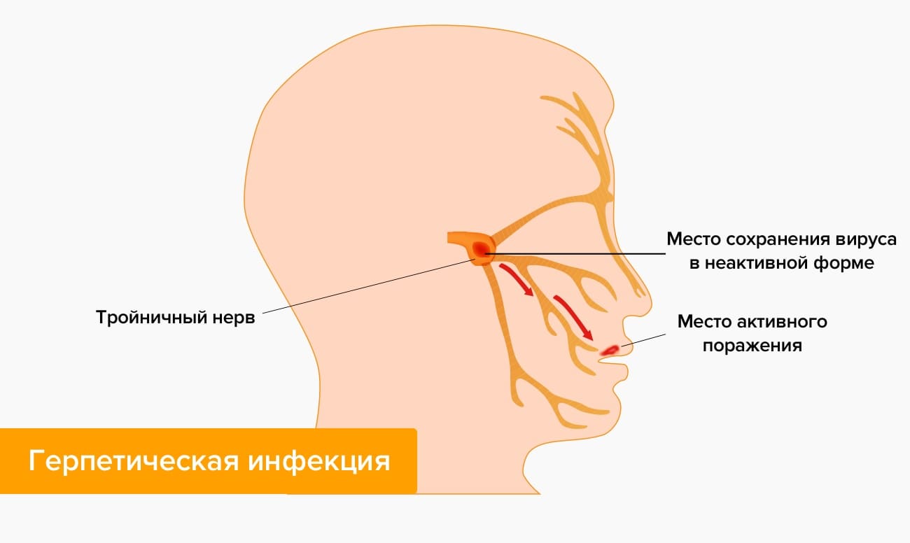 Герпетическая инфекция в картинках