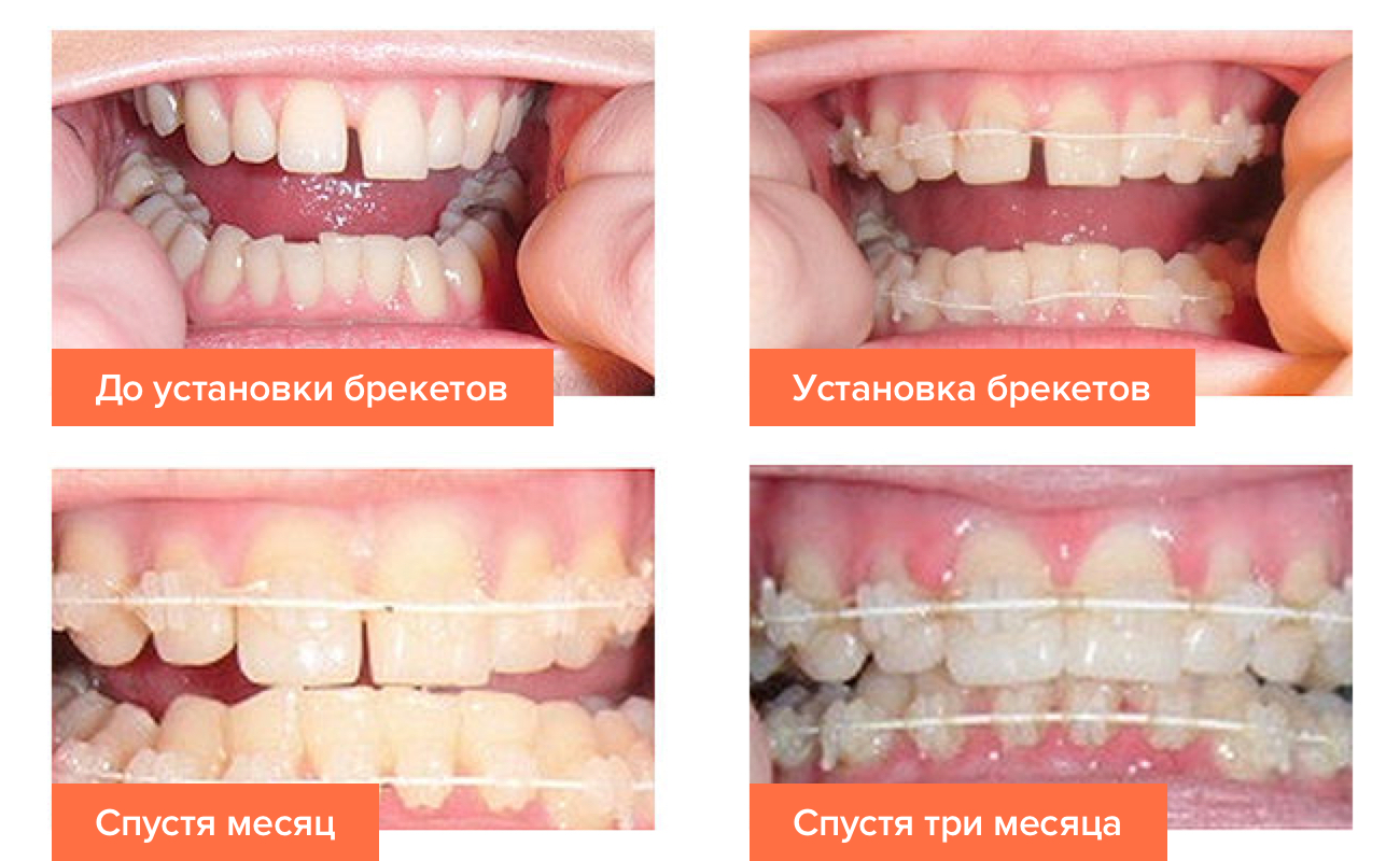 Фото этапов лечения сапфировыми брекетами