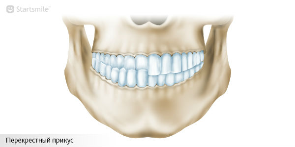 Перекрестный прикус