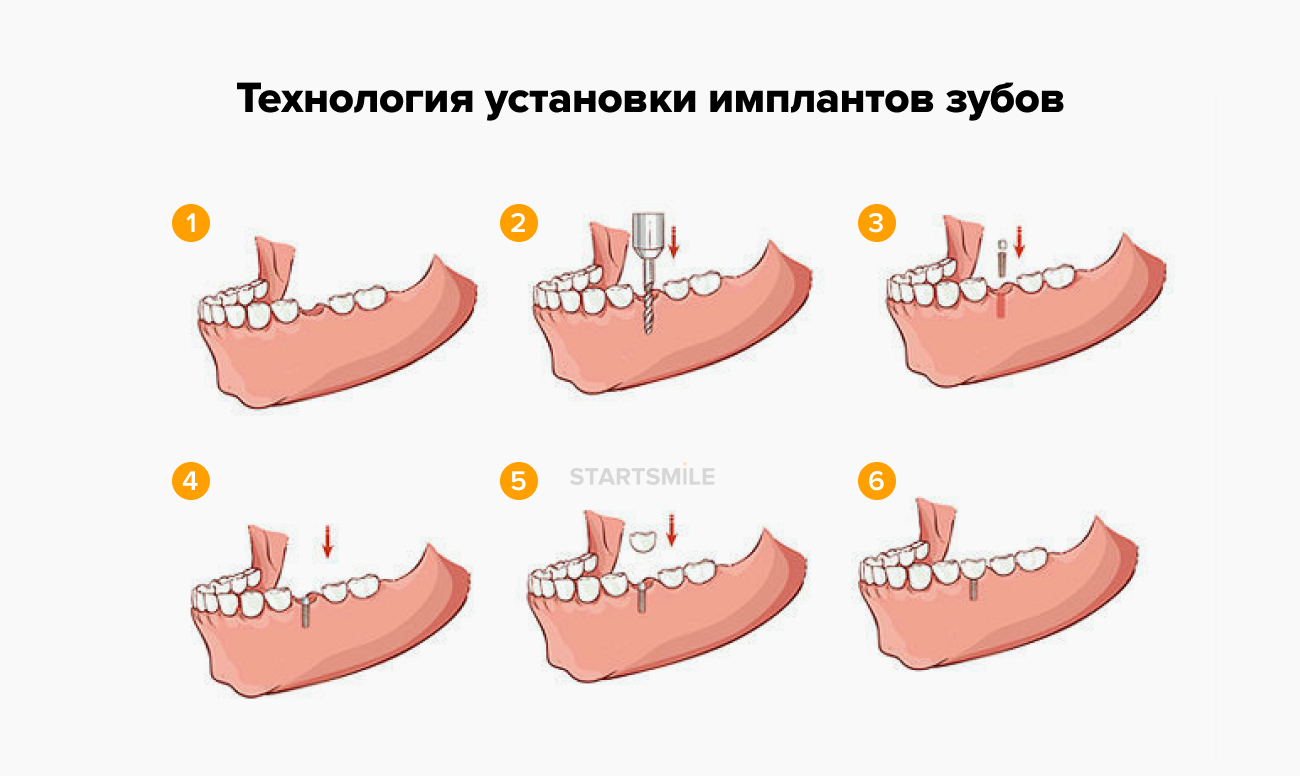 Имплантация зуба на разных этапах в картинках.