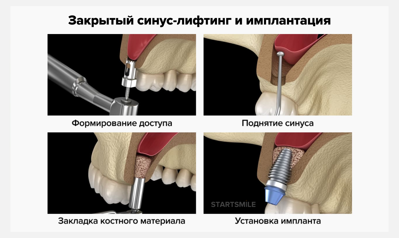 Синус десны. Синус-лифтинг (костная пластика, остеопластика). Односторонний закрытый синус-лифтинг. Методика операции синус лифтинг. Синус лифтинг закрытая методика.