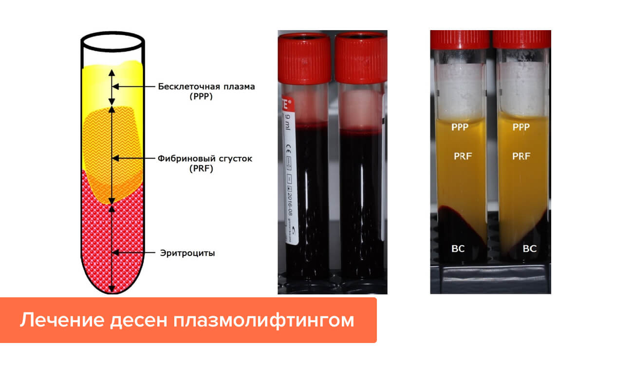 Лечение десен плазмолифтингом