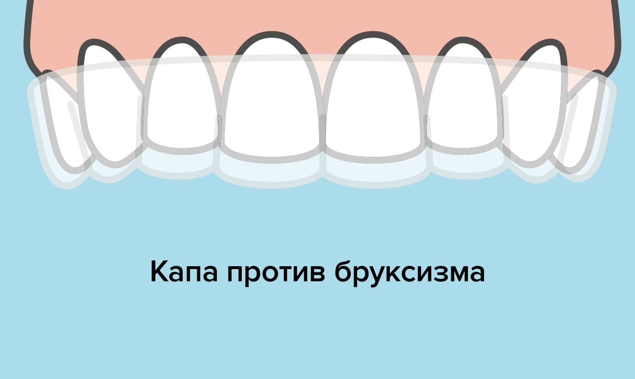 Капа против бруксизма Капа против бруксизма