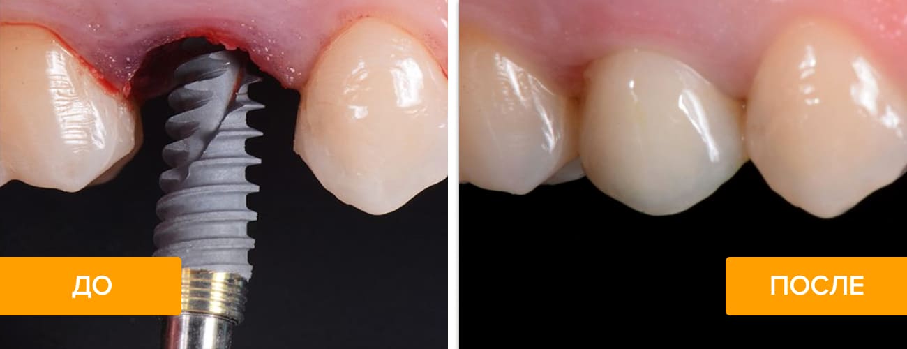 Фото до и после установки импланта NobelActive