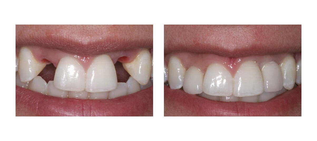 Фото пациента до и после имплантации зубов 