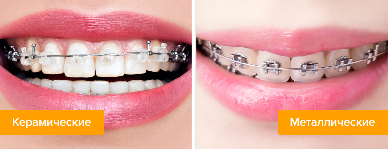 Фото керамических и металлических брекетов на зубах