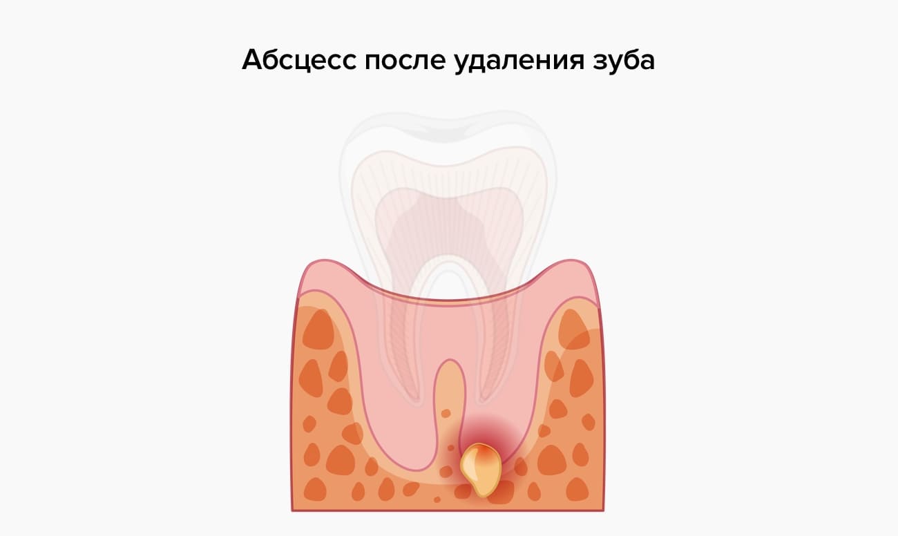 Абсцесс после удаления зуба в картинках