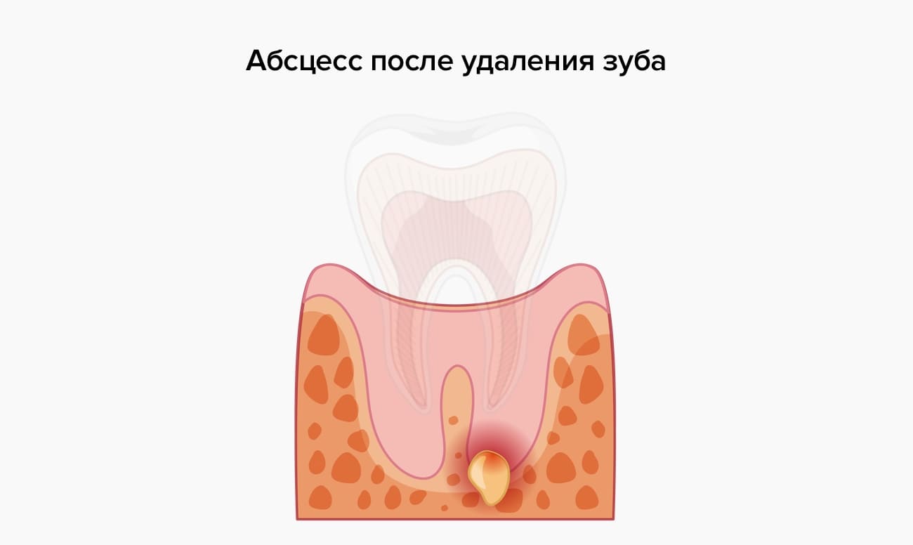 Удалили Зуб Фото После