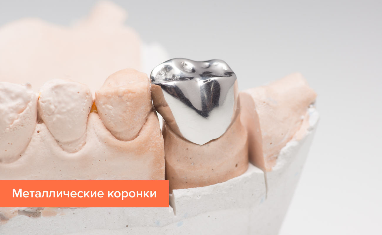 Коронка на зуб из металла Фото коронки на зуб из металла