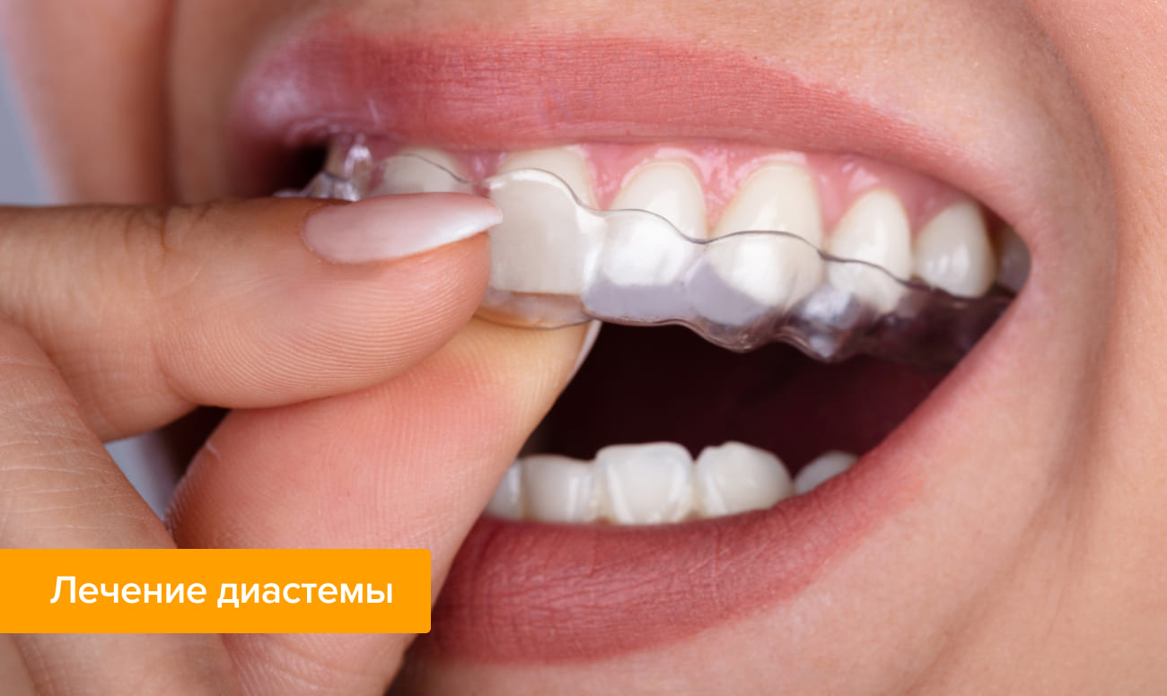 Фото элайнеров на зубах с помощью которых лечат диастему