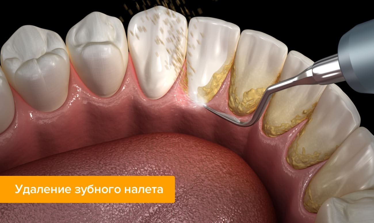 Компьютерная графика процесса удаления зубного налета 
